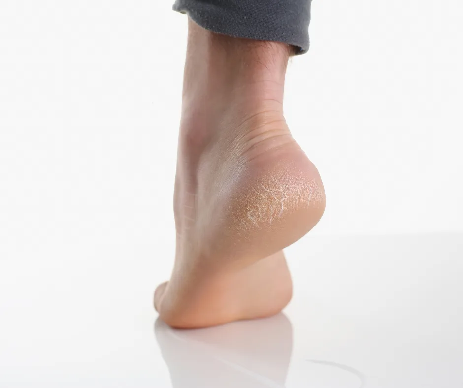 Source photograph: Cracked heels